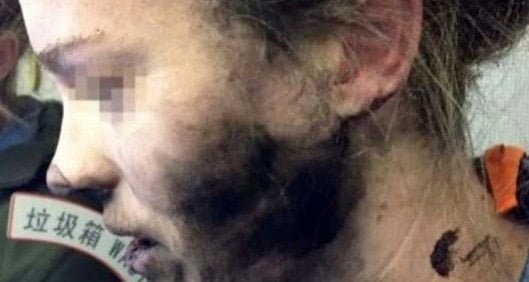 donna ustionata cuffie beats