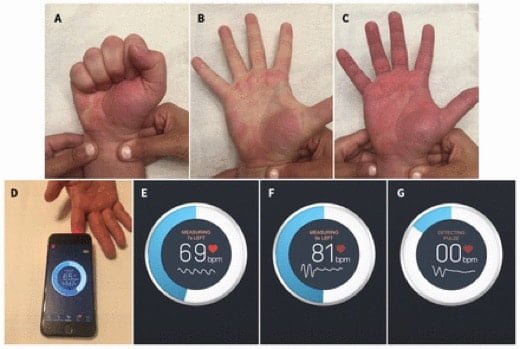 Un'app per iPhone aiuta a tracciare la salute delle arterie durante le operazioni 1 arterie app iPhone