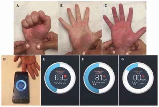Un'app per iPhone aiuta a tracciare la salute delle arterie durante le operazioni 1 arterie app iPhone